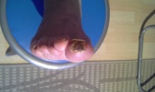 diabetična noga, zdravljenje gangrene na nogi gangrena prsta po bioterapiji
