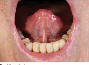 sistemska skleroza, scleroderma, naravno zdravljenje sistemska skleroza, vzrok, bioenergetik